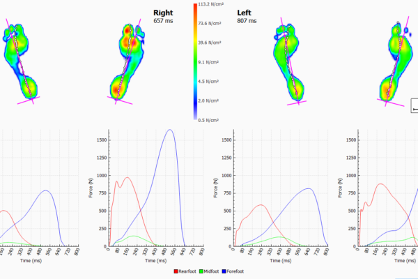 Footscan Comparison Example 3 (2)